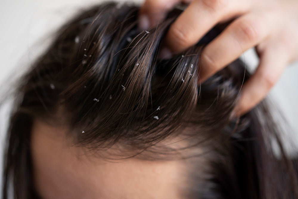 How to Choose the Right Dandruff Shampoo for Your Hair Type