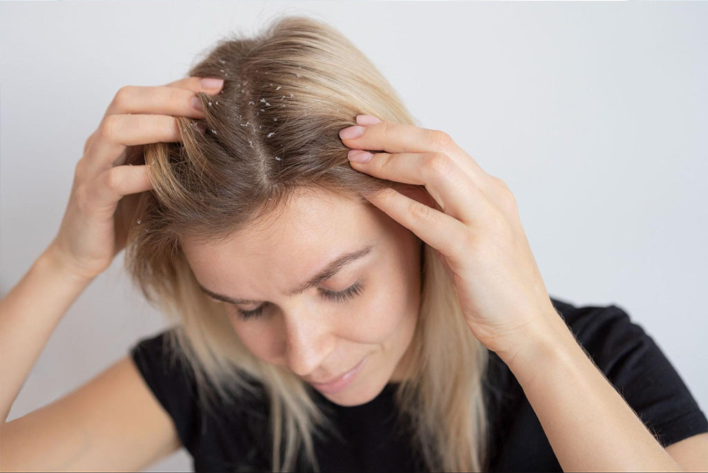 How to Treat Dandruff using the Best Anti Dandruff Shampoos and Products